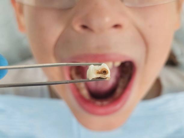 Best Emergency Treatment for Oral Infections in Punta Gorda, FL